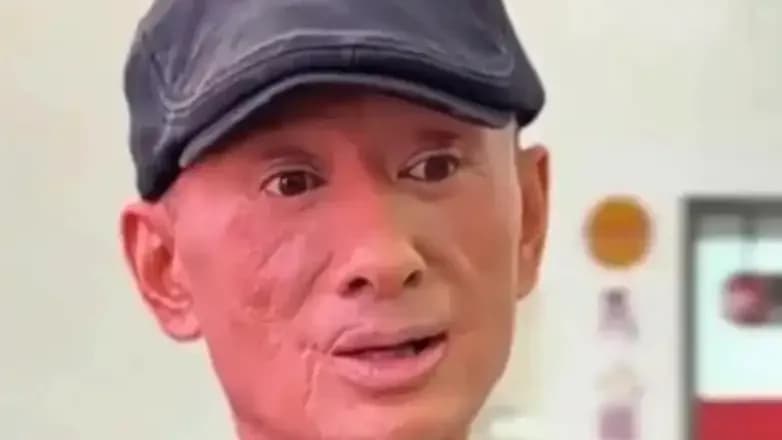 阿宝面部烧伤传闻始末：车祸手术加镜头效应，对得上吗