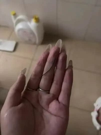左臀疼一个月挤出4厘米针头始末：筛查全阴性，来源成谜