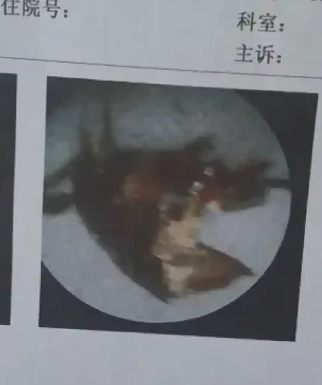 还原蟑螂钻耳：国庆睡外婆家客房，到检查单出来