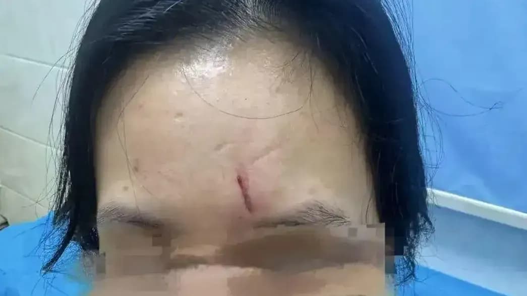 教练碰落踏板砸伤女子脸时间线：赔偿谈到第几步了