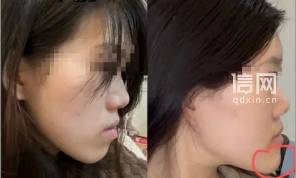 武汉女孩正颌手术变「鞋拔子脸」，卫健部门已介入调查