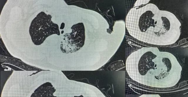虎皮鹦鹉致76岁老人进ICU：鹦鹉热是怎么回事