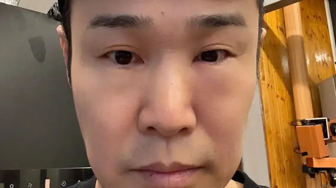 小沈阳眼睛肿成蜜蜂小狗是真的吗：自嘲逐条求证