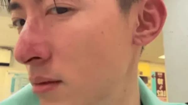 谭坤伦鼻骨受伤补偿始末:从意外到加戏,中间经历了什么
